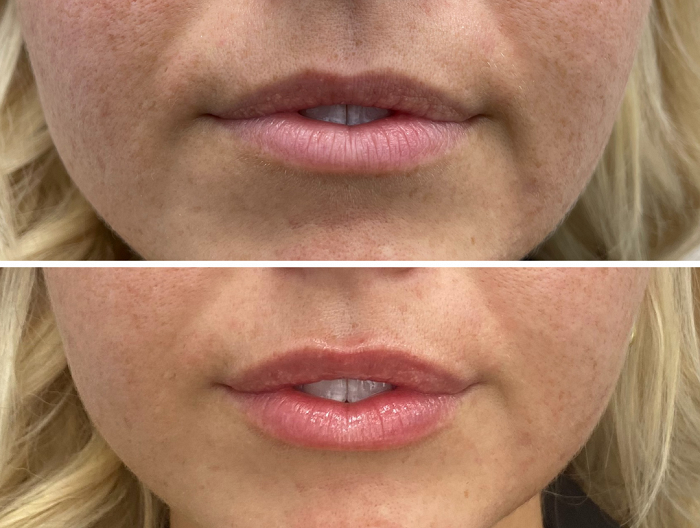 A woman having Lip treatment injections to her lips