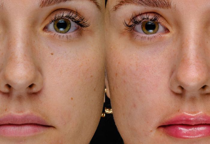 Woman’s face before and after Polynucleotides treatment
