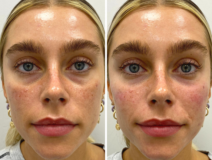Before and after result post injections of dermal filler around the eye area