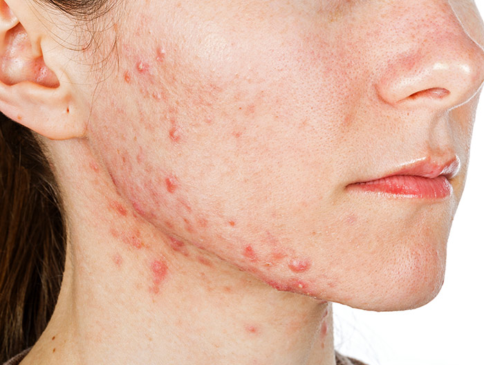 Girls cheek showing bad acne