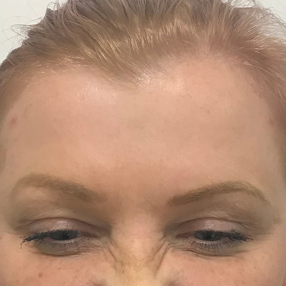 Close Up of a Woman’s Forehead