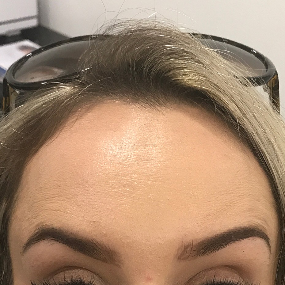 Close Up of a Woman’s Forehead