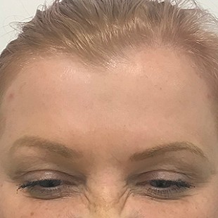 Close Up of a Woman’s Forehead
