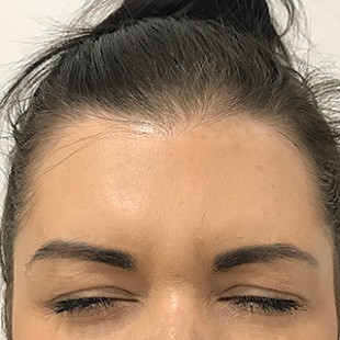 Close Up of a Woman’s Forehead
