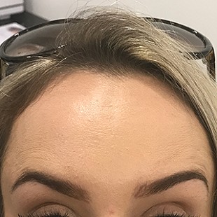 Close Up of a Woman’s Forehead