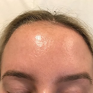 Close Up of a Woman’s Forehead