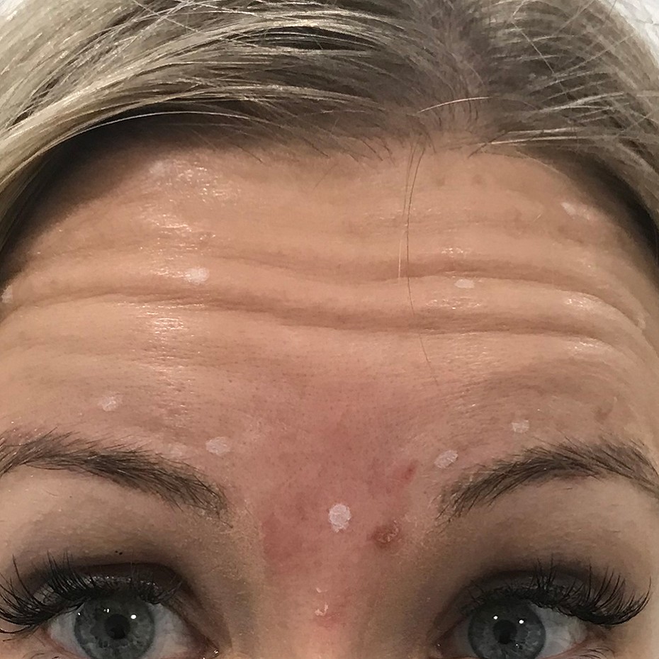 Close Up of a Woman’s Forehand showing Wrinkles