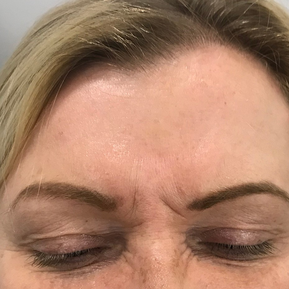 Close Up of a Woman’s Forehead