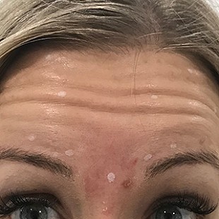 Close Up of a Woman’s Forehand showing Wrinkles