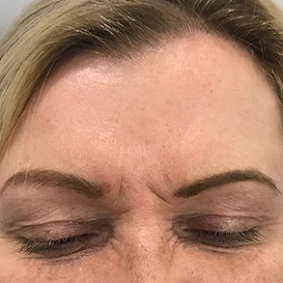 Close Up of a Woman’s Forehead