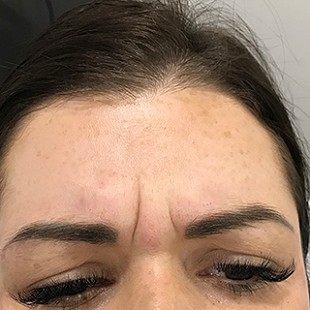 Close Up of a Woman’s Forehead