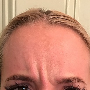 Close Up of a Woman’s Forehead