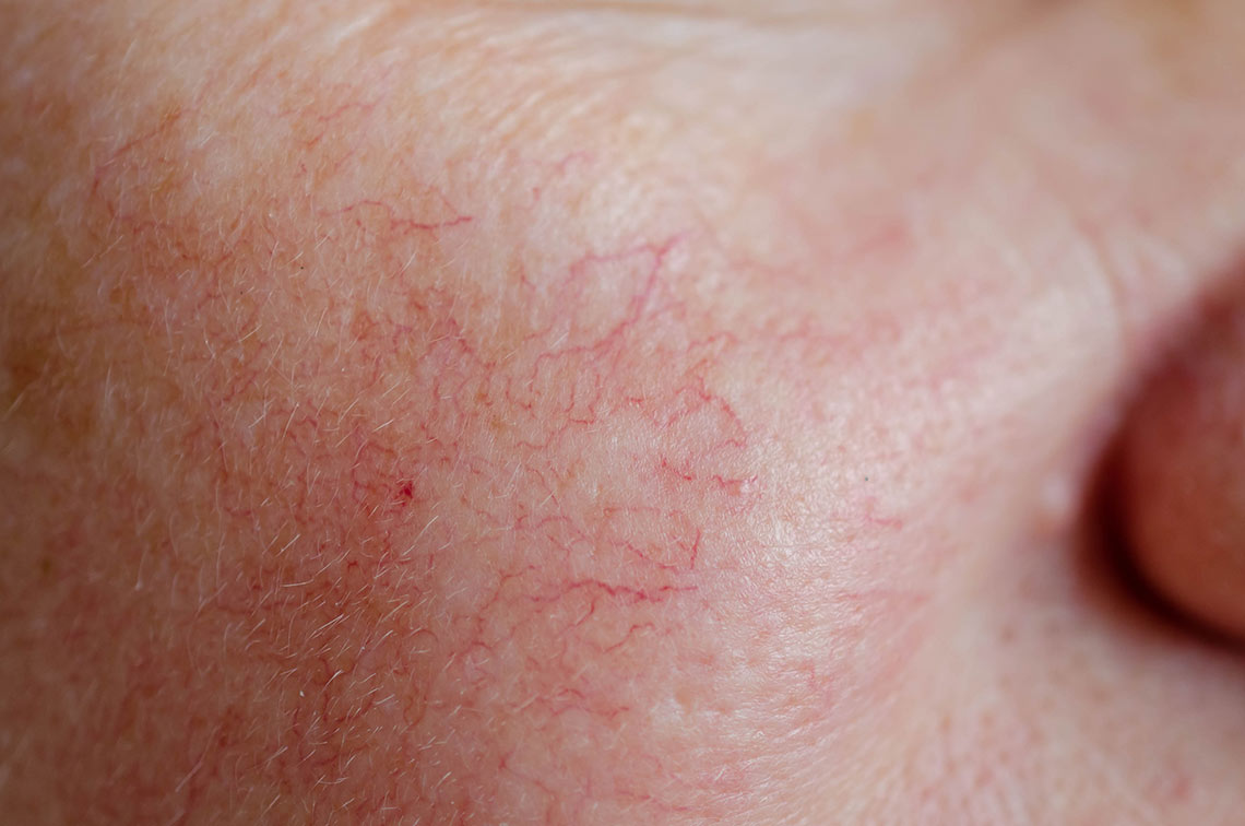 Close up of facial thread veins on a cheek