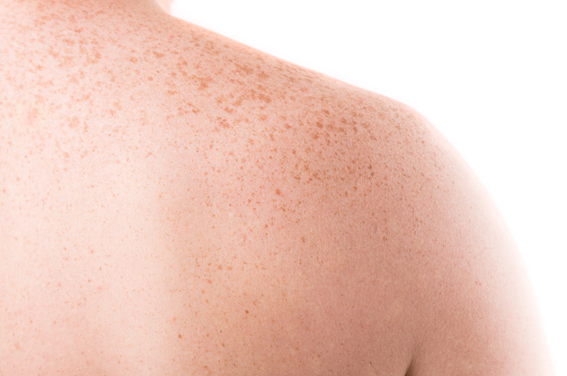 Freckles shown on a ladies shoulder