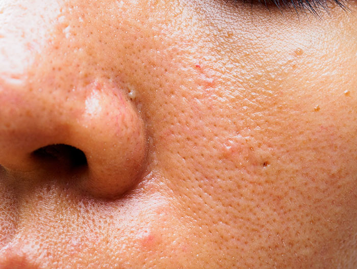 Side of the nose and cheek showing large pores