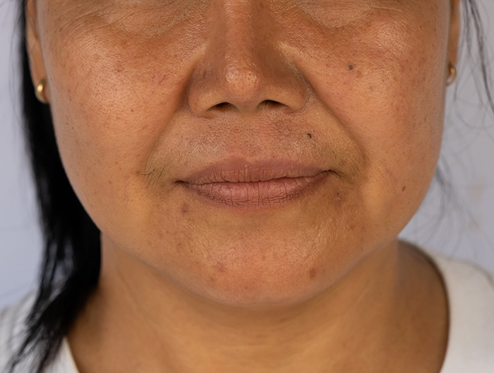 Ladies face showing Nasolabial Folds