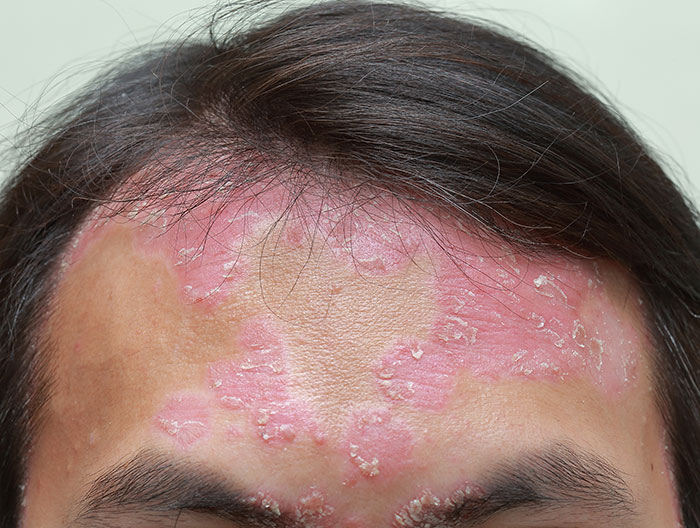 Forehead and hairline showing severe psoriasis