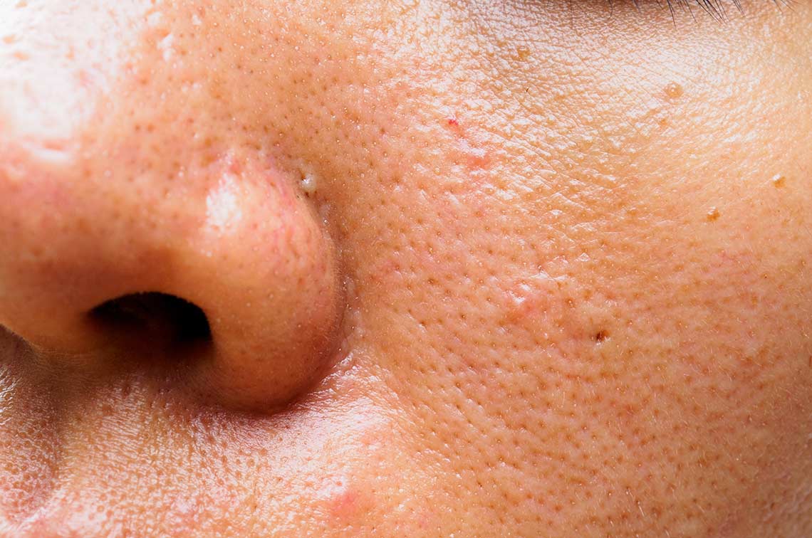 Close up of ladies nose and cheek showing large pores