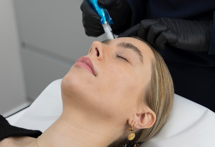 Microneedling treatment in progress to the forehead