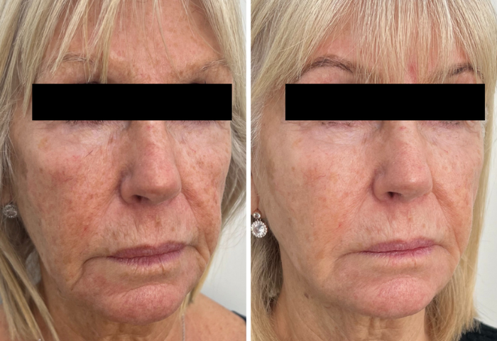 A ladies face after dermal filler treatment