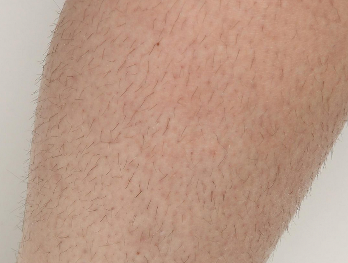 Patients’ leg before Diolaze laser hair removal treatment