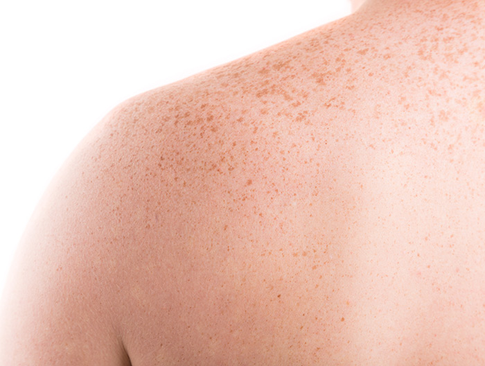 Girls shoulder showing freckles