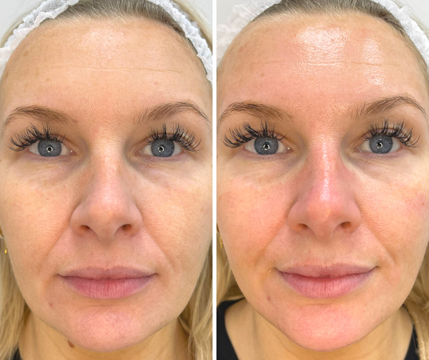 Man having Hydrafacial Treatment to the Forehead