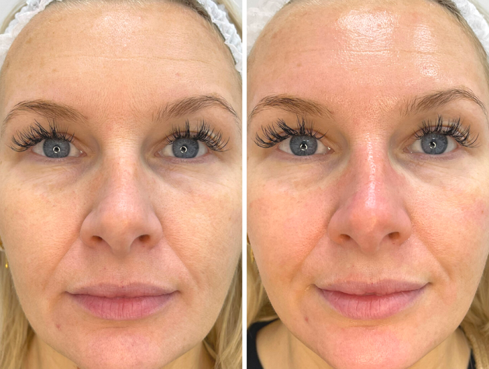 HydraFacial before and after results, dull to dewy skin