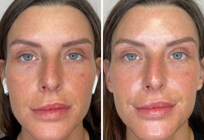 Close up of a woman’s face before (left) and after Hydrafacial treatment