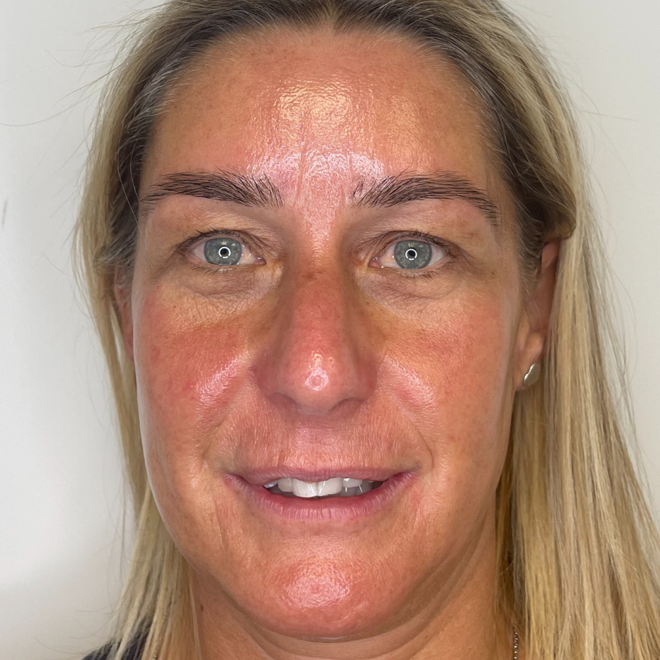 Front view of a ladies face after HydraFacial treatment