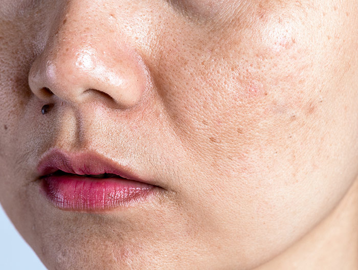 Ladies cheek and mouth showing Hyperpigmentation