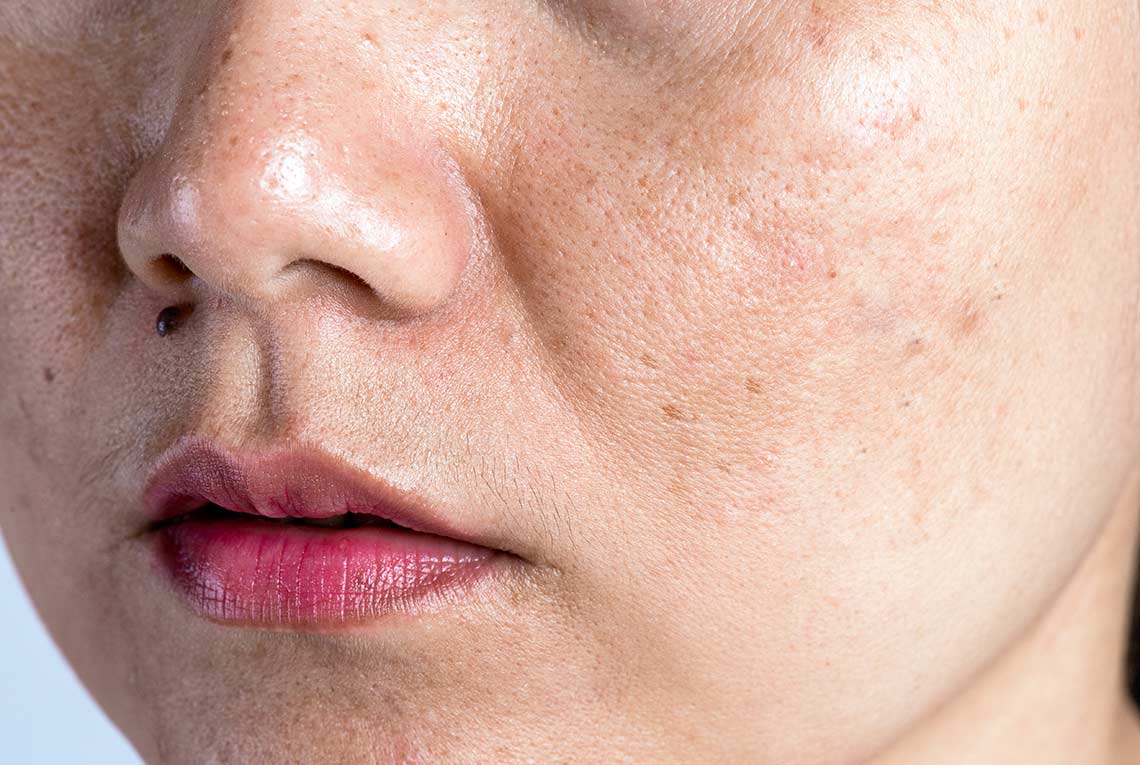 Close up of a ladies nose, cheeks & Lips showing Hyperpigmentation