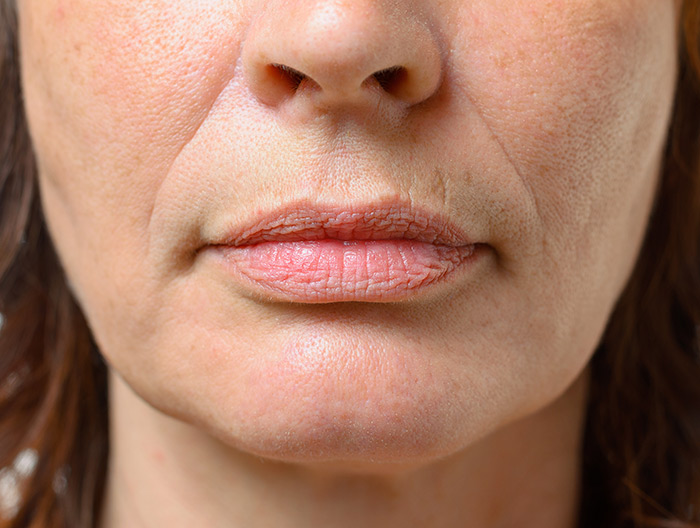 Close Up of a chin showing Jowls