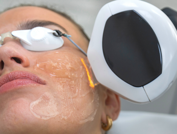 Lady having Lumeeca treatment to the cheek