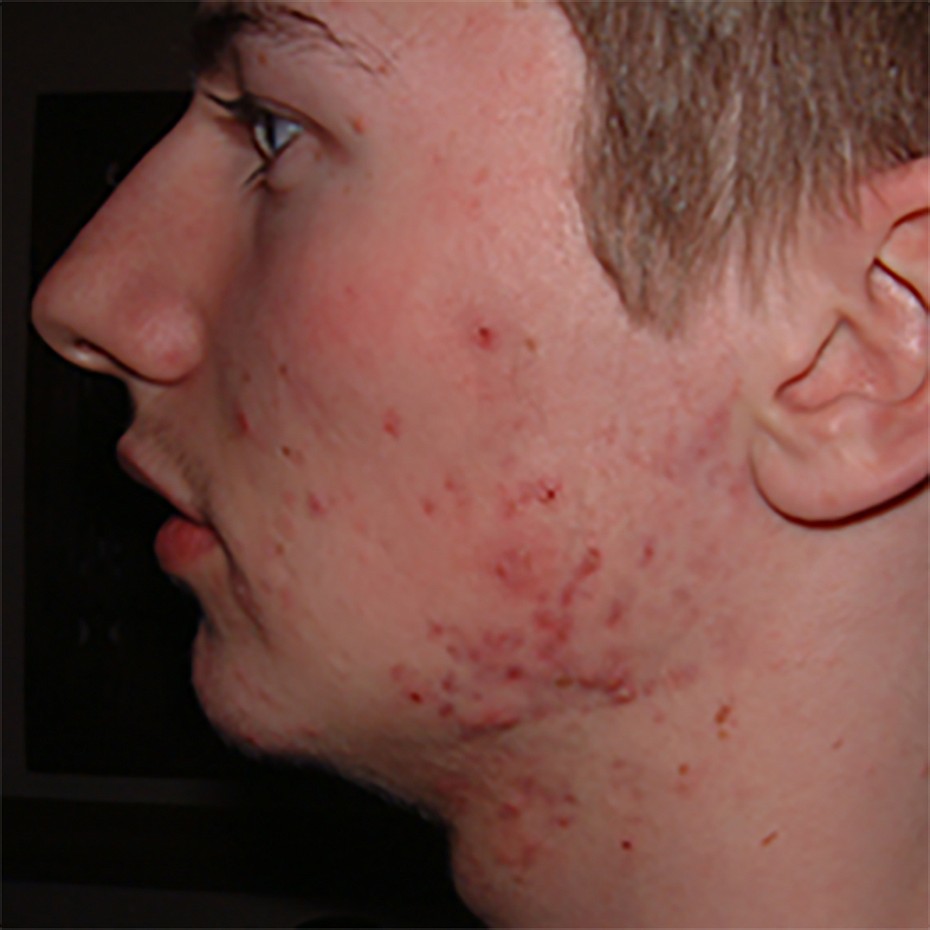 Side View of a boys face showing spots