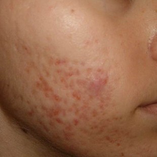 Close up of a girls cheek showing spots