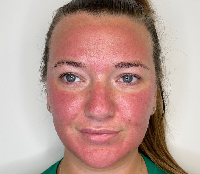 Woman with red face post microneedling treatment