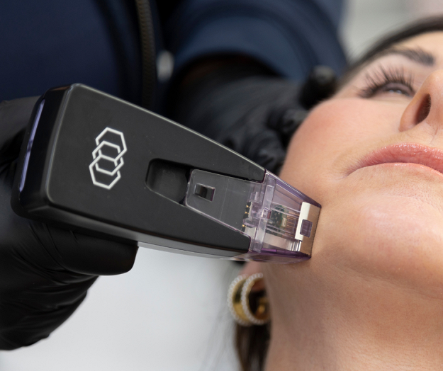 Woman having Morpheus8 treatment to the face