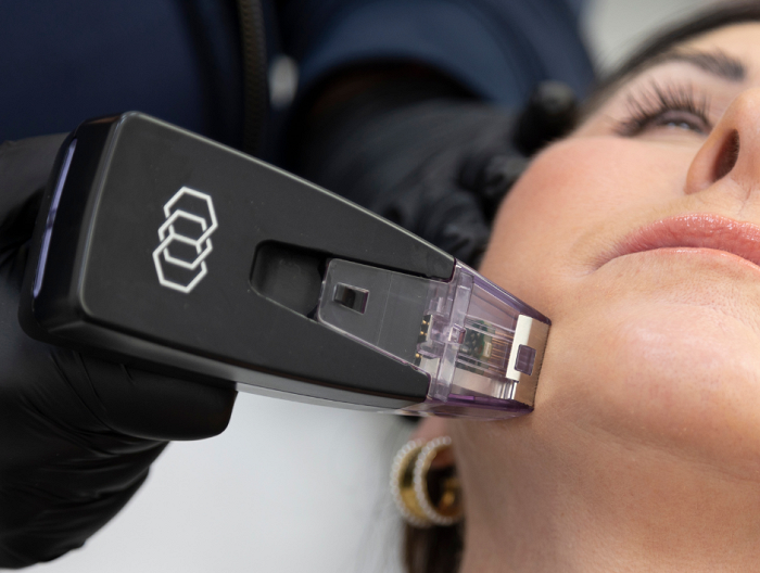 A woman having Morpheus8 treatment to her cheek in the Clinic