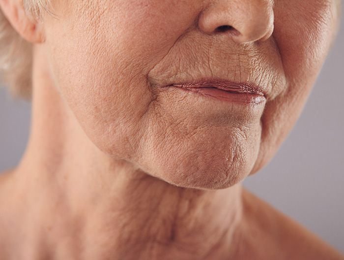 Elderly lady with chin & neck wrinkles