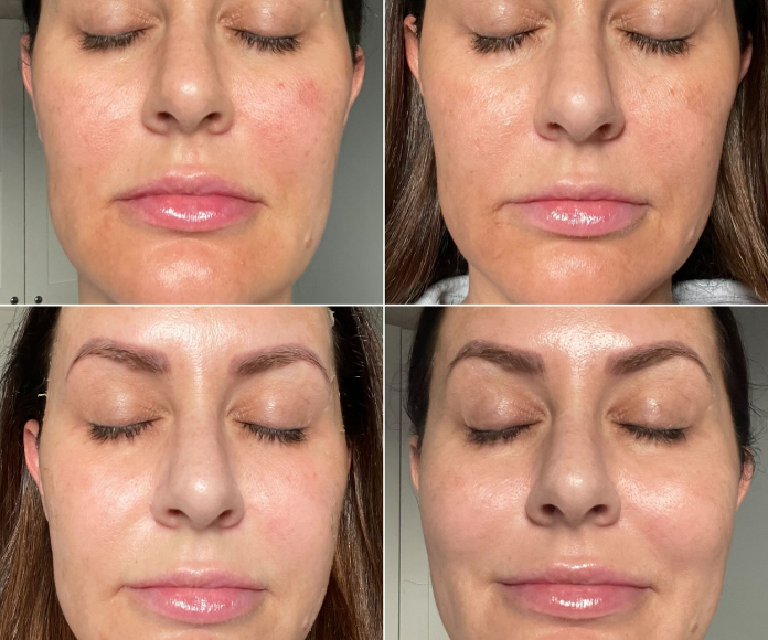 Close up of woman's face during 4 stages of The Perfect Peel treatment