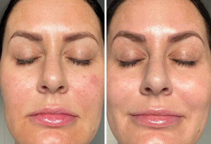 The Perfect Peel™ Skin Peel before (left) and after