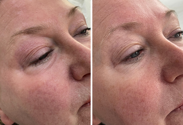 Close up of a woman’s face before (left) and after Polynucleotides treatment at Eterno Aesthetics skincare clinic in Sheffield