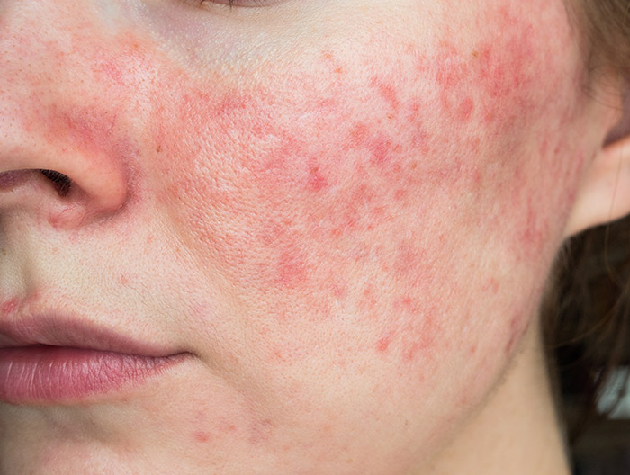 Rosacea skin complaint on a ladies cheek