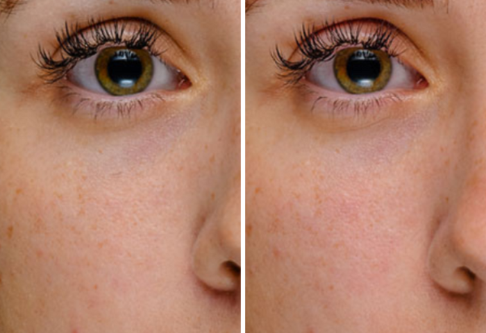 Close up of a woman’s face before (left) and after Redensity 1 treatment