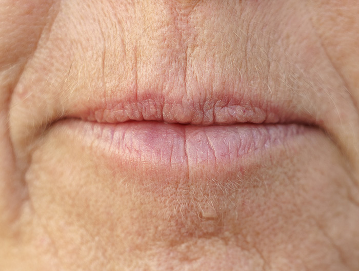 Close up of a ladies lips showing Smokers Lines