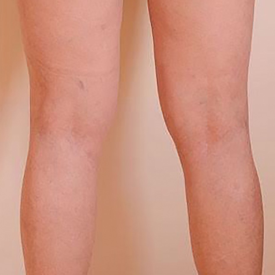 Legs after thread vein treatment