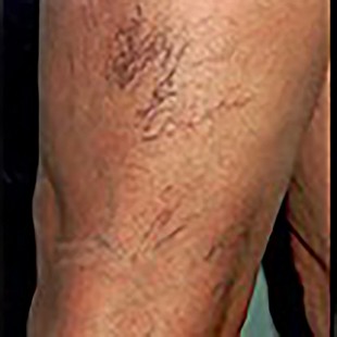 Legs before thread vein treatment