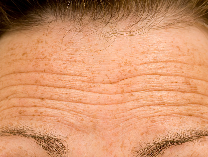 Close Up of a ladies forehead showing wrinkles whilst frowning