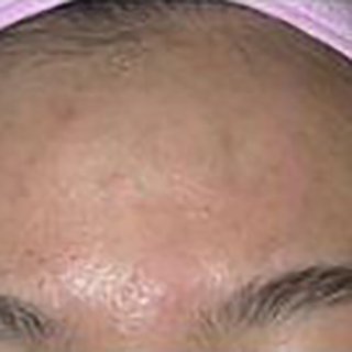 Forehead with clear skin complextion